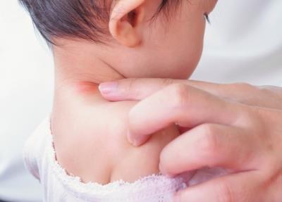 5 ways to manage childhood allergies  By Dr Nidhi Gupta
