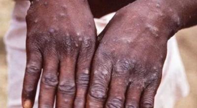 Monkeypox cases rise to 6 in Netherlands