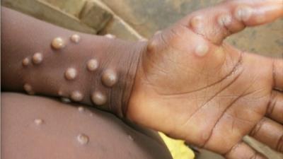 Monkeypox cases rise to 84 in Spain